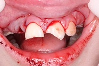  Οδοντικό τραύμα